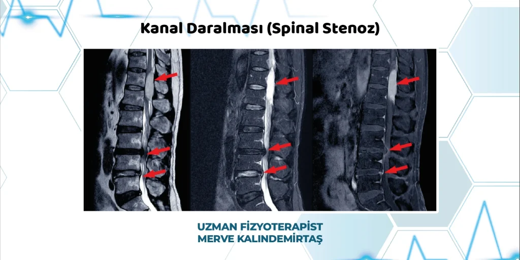 Kanal Daralması (Spinal Stenoz)