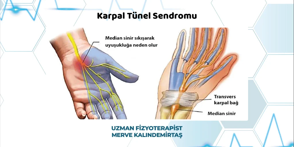 Gaziantep Karpal Tünel Sendromu