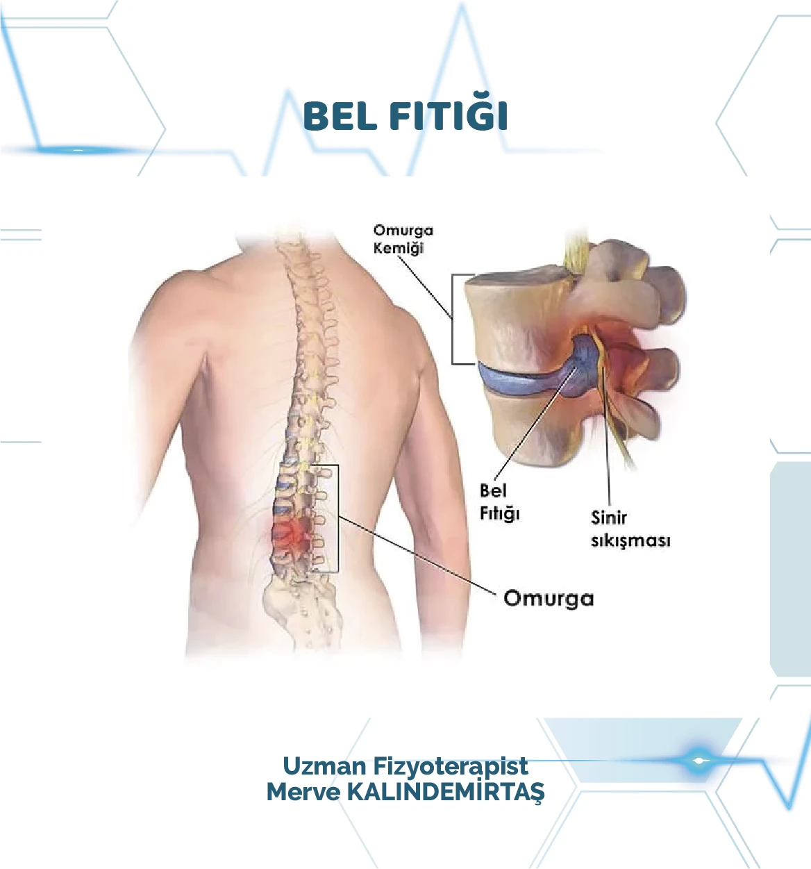 Bel fıtığı tedavisi
